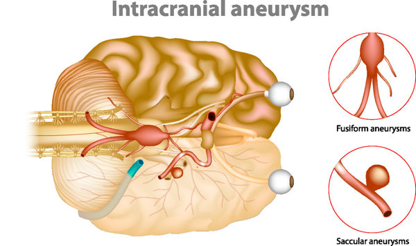 颅内动脉瘤治疗新技术